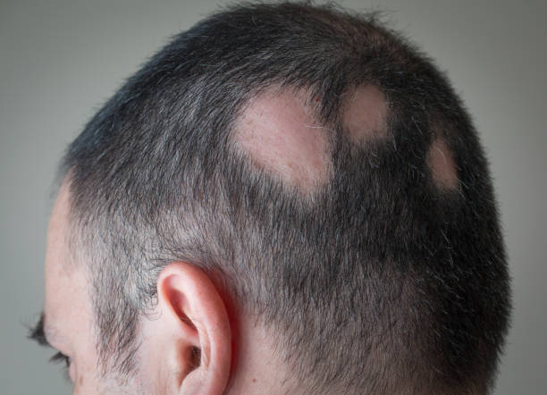 Mezoterapi ile Alopesi Areata (Saç Kıran) Tedavisi